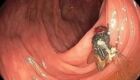 Homem descobre mosca viva no intestino durante exame de rotina