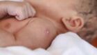 A vacina BCG deve ser aplicada, preferencialmente, logo após o nascimento