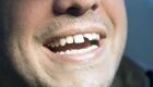 Dentes quebrados | Imagem ilustrativa