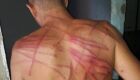 Militares do 41ºBPM (Irajá) agrediram rapaz com um fio de energia elétrica, deixando sérios ferimentos nas costas da vítima