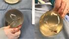 Implante de silicone salva mulher que foi baleada no peito