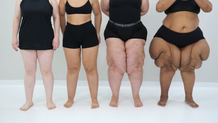 JD1TV: Mês de conscientização do lipedema chama atenção para doença pouco diagnosticada  