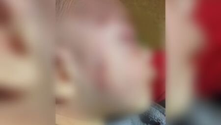 Beb&ecirc; ficou com v&aacute;rios hematomas