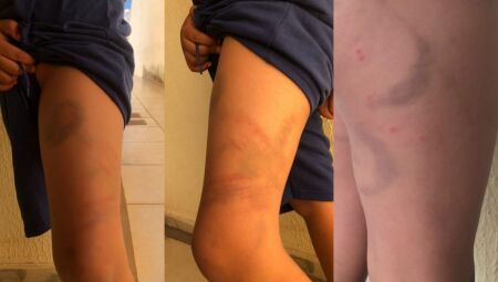 Marcas no corpo da crian&ccedil;a - Foto:WhatsApp / JD1