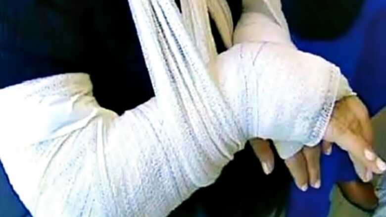 Para se defender ela colocou o bra&ccedil;o na frente