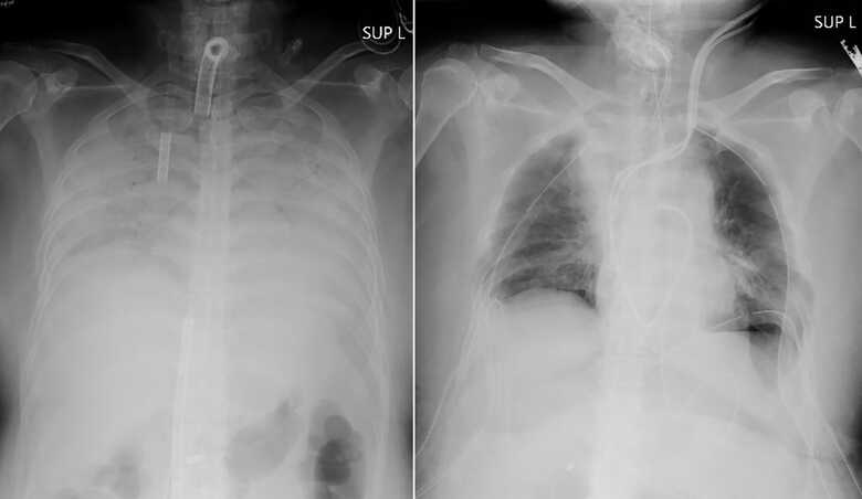 Radiografias fornecidas em 9 de abril de 2021 pelo Hospital mostram o tórax de um paciente antes da cirurgia e depois