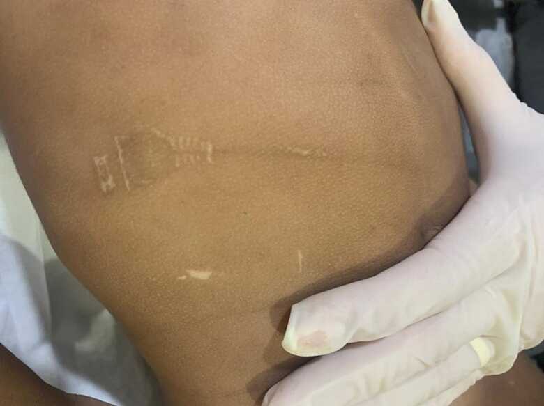 Marcas de agress&atilde;o com fios na crian&ccedil;a