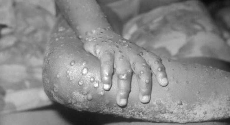Varíola símia causa pústulas pelo corpo e febre 
