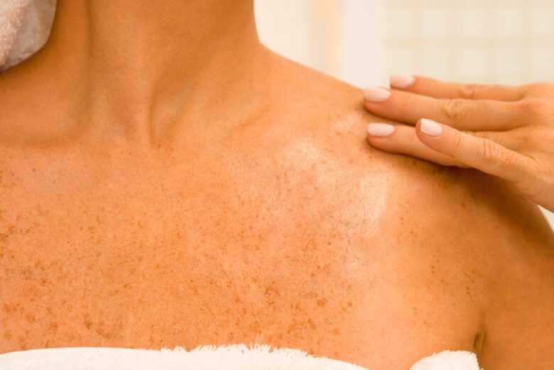 Banho de sol deve ser moderado para evitar doenças como o câncer de pele