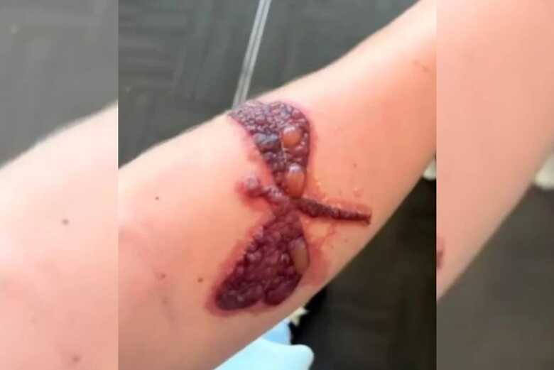 Tattoo feita com henna provoca queimaduras
