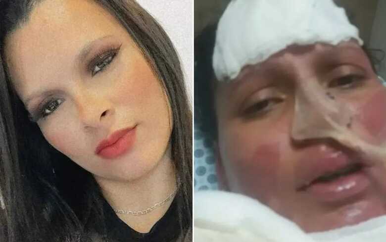 Dara Cristina de Andrade Rossato sofreu graves queimaduras após ser atacada pelo marido em Franca, SP