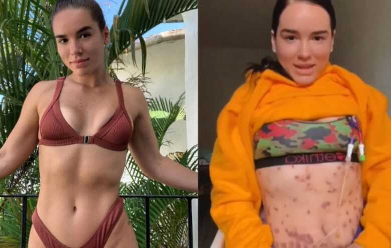 A&nbsp;bact&eacute;ria age decompondo os tecidos&nbsp;e pode infectar a pele e tecidos moles