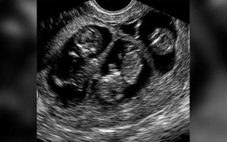 ultrassom de trig&ecirc;meos