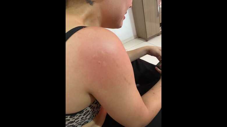 Marca deixada por mordida de m&eacute;dico no ombro de estudante.