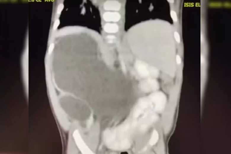 Isis nasceu prematura, tem alguns atrasos motores, mas leva uma vida normal.