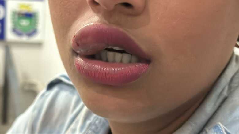 Marido mordeu os l&aacute;bios causando uma les&atilde;o na pr&oacute;pria esposa