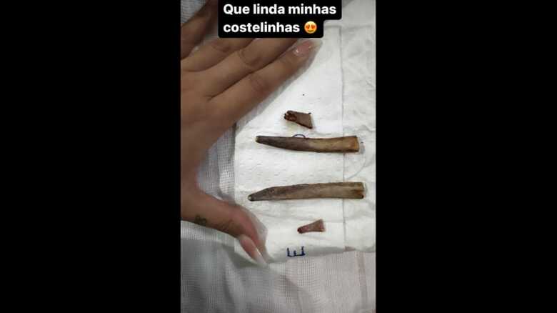 Modelo exibiu os ossos retirados em publicação no Instagram