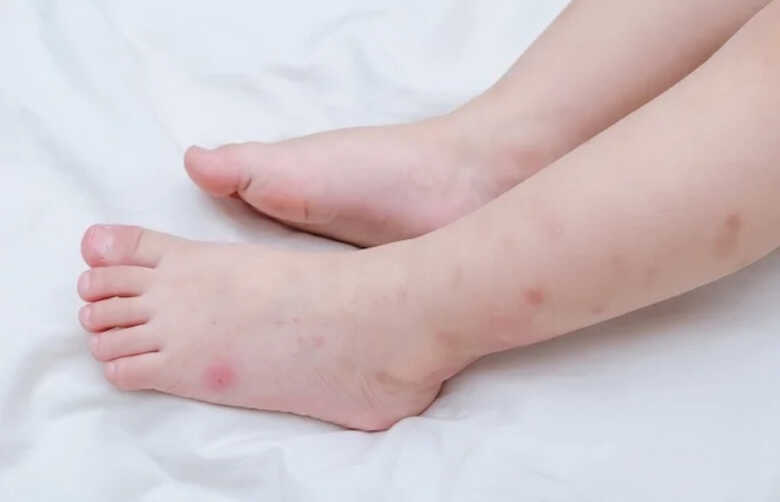 Criança com manchas no corpo em decorrência da dengue