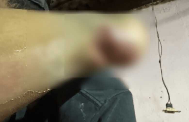 A crian&ccedil;a, de 1 ano e 11 anos, teria precisado colocar um gesso ap&oacute;s trincar o p&eacute; e tudo desandou por conta disso