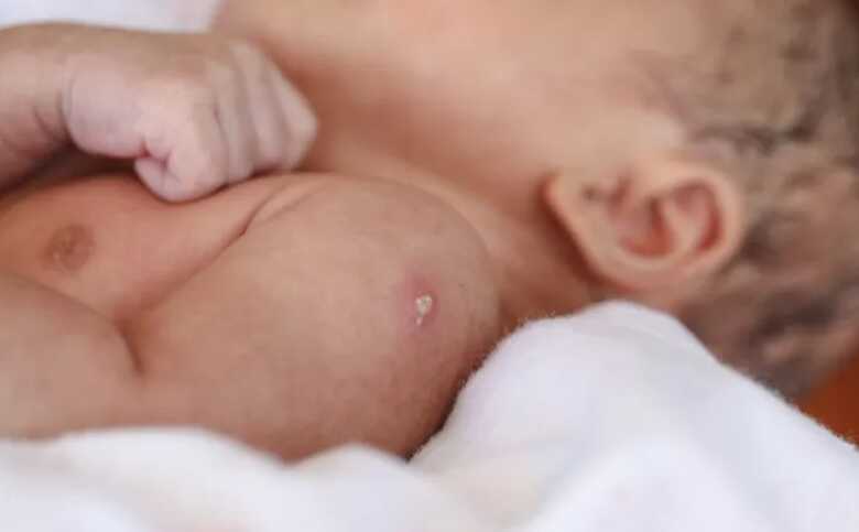 A vacina BCG deve ser aplicada, preferencialmente, logo após o nascimento