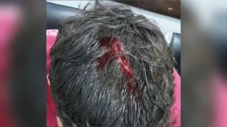 Adolescente levou um tiro de raspão na cabeça