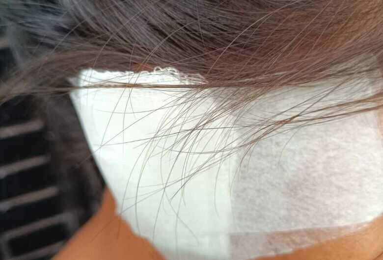 Mulher teve parte do membro arrancado "no dente" 