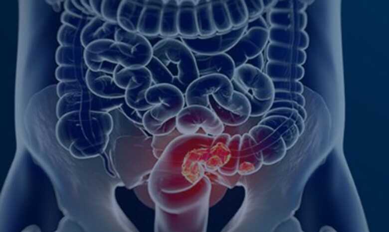 Diretriz vai passar por consulta p&uacute;blica e ser&aacute; analisada pela Conitec