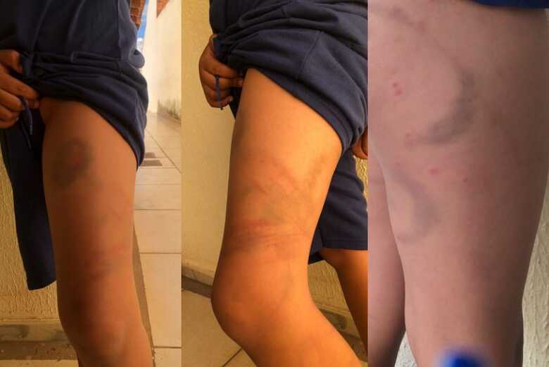 Marcas no corpo da crian&ccedil;a - Foto:WhatsApp / JD1