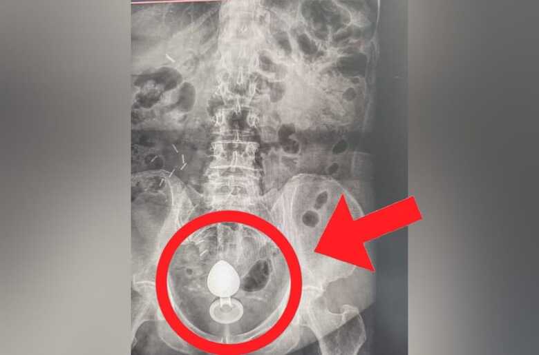 Raio-x mostra com plug anal no intestino  Foto: Reprodu&ccedil;&atilde;o