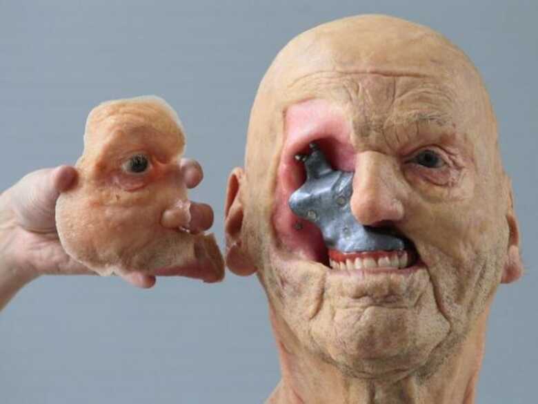 Prótese da Materialise recria partes estruturais do corpo humano que estão faltando.