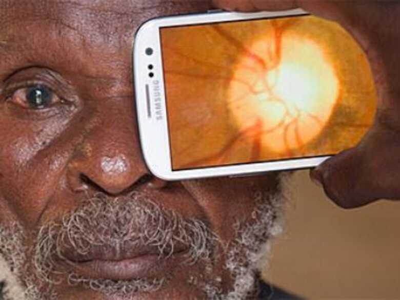 Aplicativo usa a câmera do celular para examinar os olhos e detectar a catarata. (Foto: Andrew Bastawrous/BBCBrasil.com)