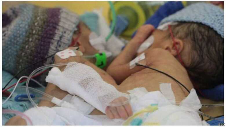 As g&ecirc;meas, nascidas em dezembro, estavam conectadas pelo f&iacute;gado e pelo t&oacute;rax (Imagem: reprodu&ccedil;&atilde;o)