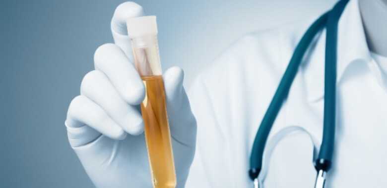 'Doença da urina preta' causa dor muscular intensa, mudança na cor do xixi e insuficiência renal