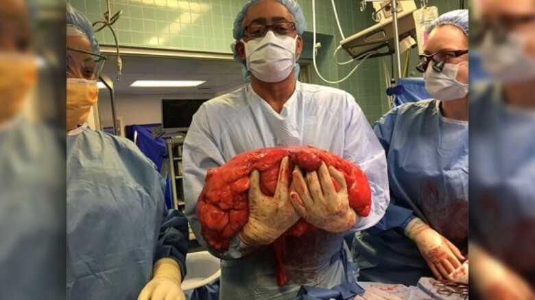 O americano precisou passar por uma cirurgia cardíaca