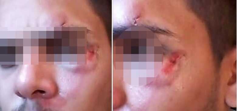 A vítima teve diversos hematomas no rosto