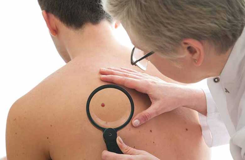 O câncer de pele não melanoma corresponde a 30% dos tumores malignos diagnosticados no Brasil