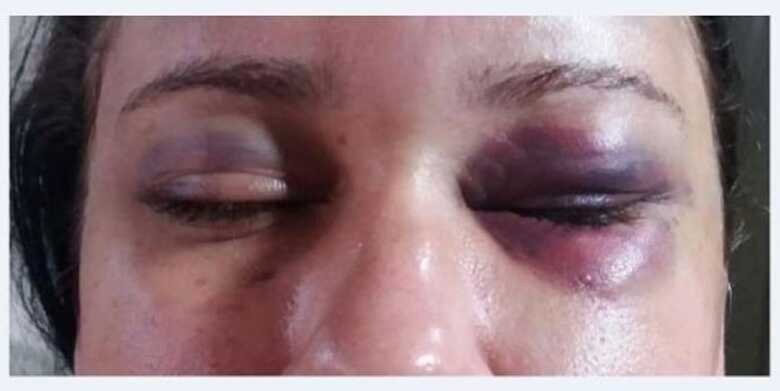 A vítima desmaiou após a sessão de tortura e ficou com os olhos roxos