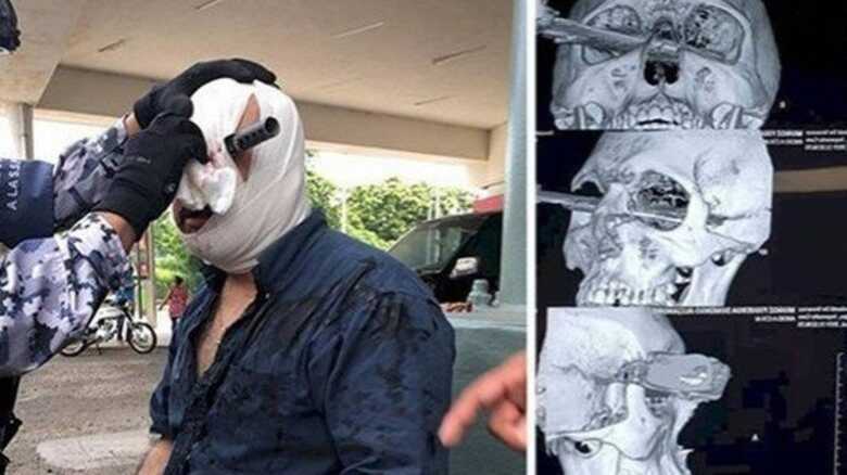 O estado de Domingo Alejandro &eacute; est&aacute;vel, mas ele perdeu a vis&atilde;o do olho esquerdo