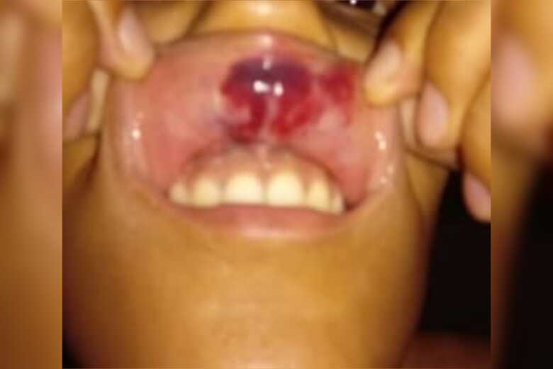 Dayana Soares teve um corte na boca devido a agress&atilde;o que sofreu por parte de um dos gar&ccedil;ons do estabelecimento