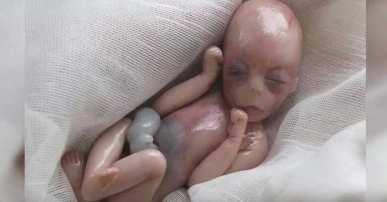 Policiais estimam que feto era de aproximadamente de 5 meses e tinha sexo masculino