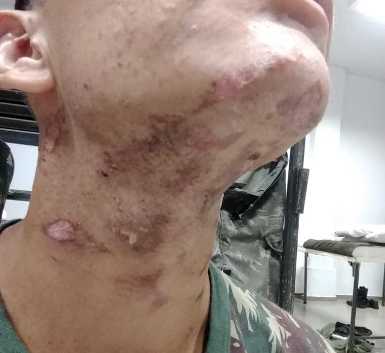 O jovem de 18 anos teve seu pescoço, nuca e parte das orelhas queimadas