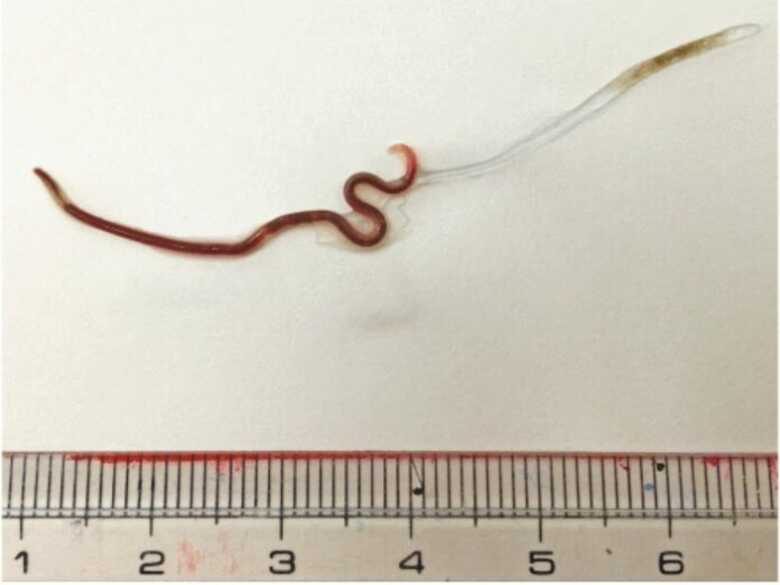 Parasita encontrado nas am&iacute;gdalas da paciente tinha quase 5cm