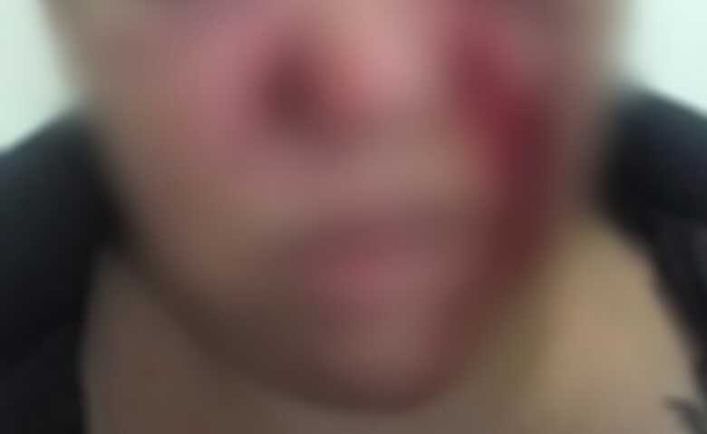 Ele foi encaminhado para a delegacia e a mulher para uma unidade de sa&uacute;de para atendimento m&eacute;dico, pois seu nariz quebrou devido &agrave;s agress&otilde;es