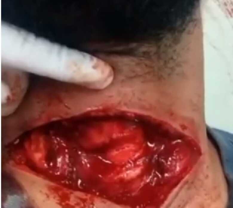 Homem quase morre ao ter pescoço profundamente cortado por linha de cerol