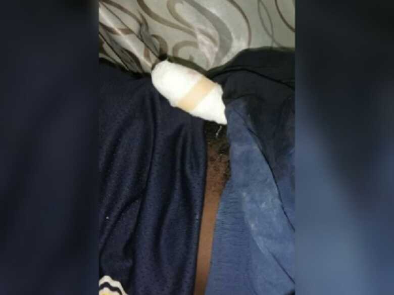 A parte do p&ecirc;nis cortada foi recuperada e implantada