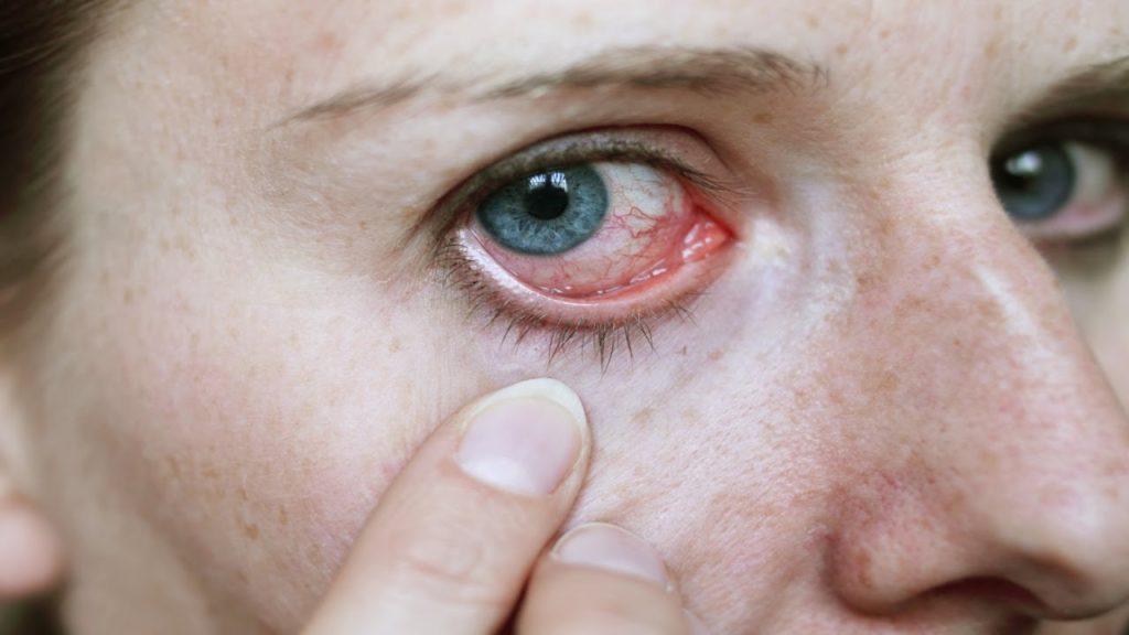 Britânica perde o olho após rara infecção causada por fungo